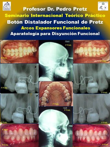 11 PÓSTER JUNIO 2013
DR. PEDRO PRETZ
EXPANSORES Y DISTALADORES FUNCIONALES